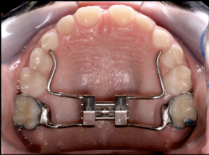 Palate Expander for Phase 1